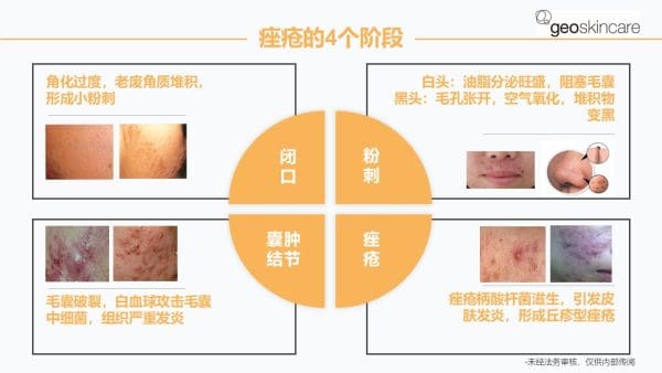 Anti-Acne & Purufying Serum - Image 4